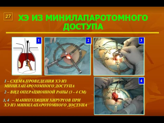 ХЭ ИЗ МИНИЛАПАРОТОМНОГО ДОСТУПА 1 – СХЕМА ПРОВЕДЕНИЯ ХЭ ИЗ МИНИЛАПАРОТОМНОГО