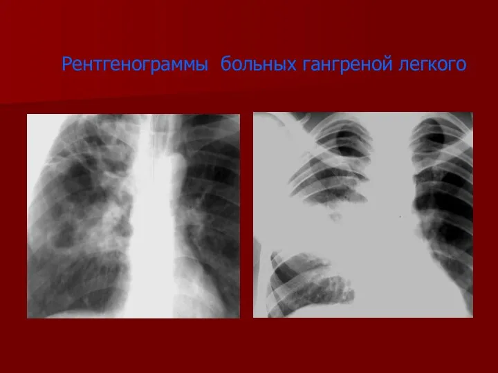 Рентгенограммы больных гангреной легкого