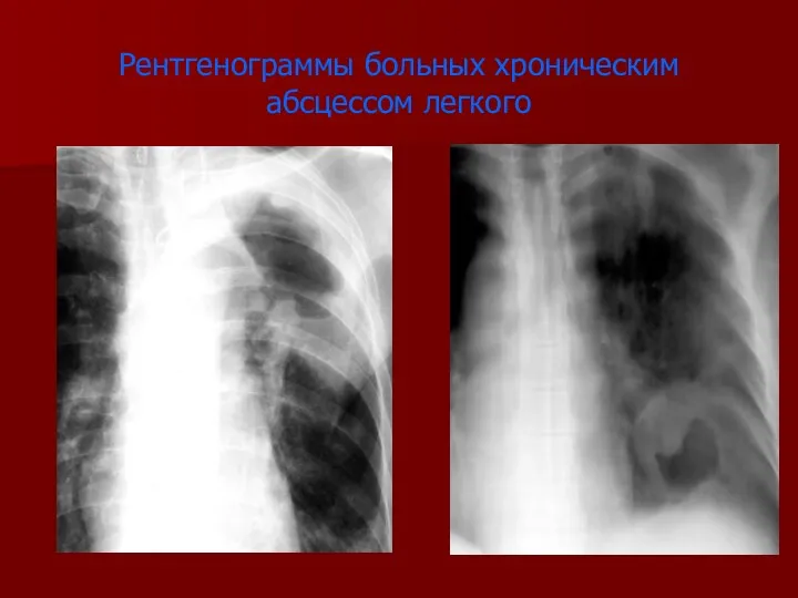 Рентгенограммы больных хроническим абсцессом легкого
