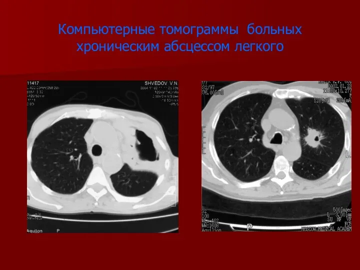 Компьютерные томограммы больных хроническим абсцессом легкого