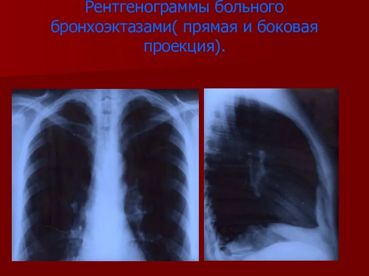 Рентгенограммы больного бронхоэктазами( прямая и боковая проекция).