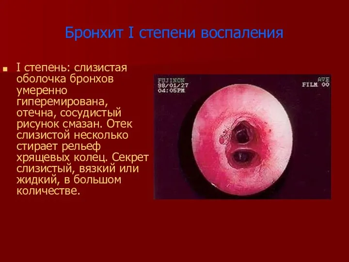 Бронхит I степени воспаления I степень: слизистая оболочка бронхов умеренно гиперемирована,