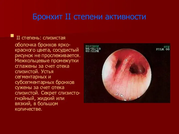 Бронхит II степени активности II степень: слизистая оболочка бронхов ярко-красного цвета,