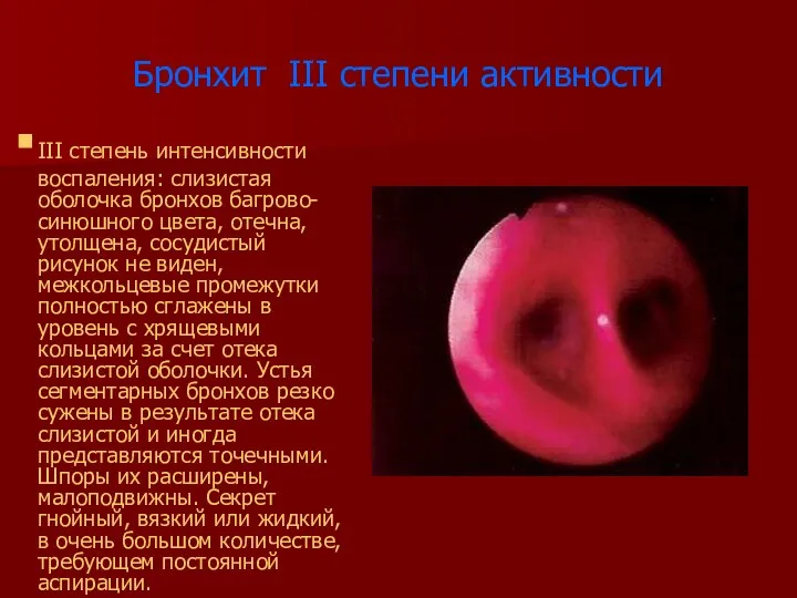 Бронхит III степени активности III степень интенсивности воспаления: слизистая оболочка бронхов