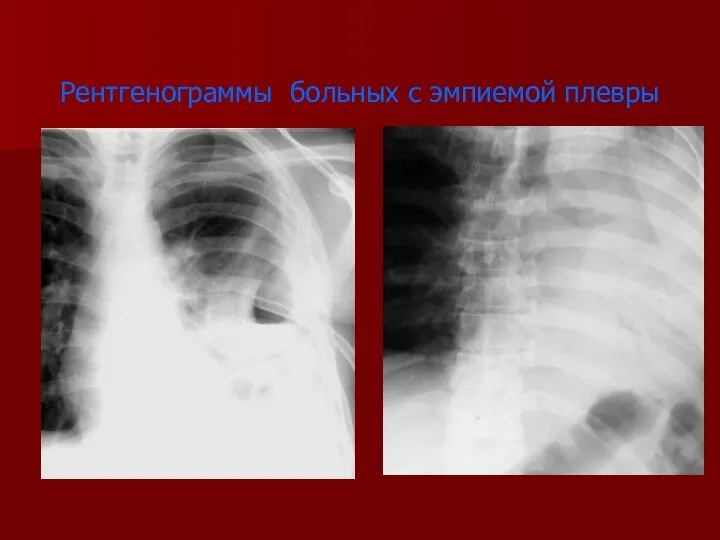 Рентгенограммы больных с эмпиемой плевры