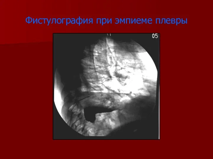 Фистулография при эмпиеме плевры