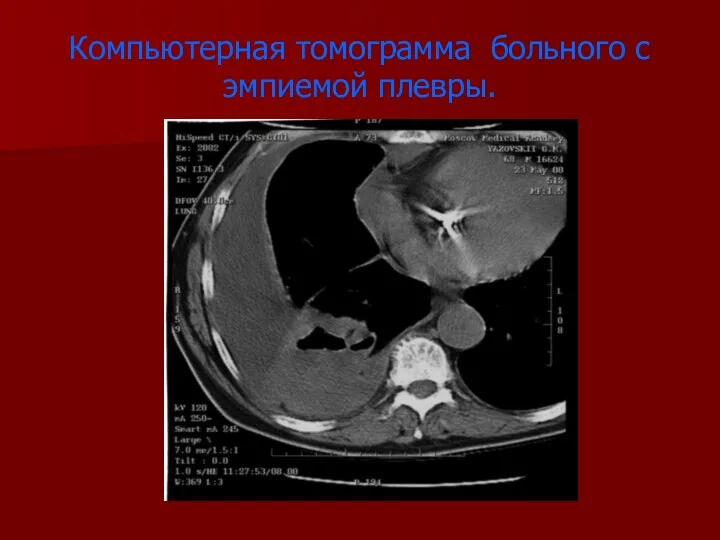 Компьютерная томограмма больного с эмпиемой плевры.