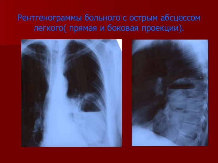 Рентгенограммы больного с острым абсцессом легкого( прямая и боковая проекции).