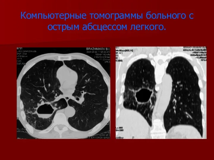 Компьютерные томограммы больного с острым абсцессом легкого.