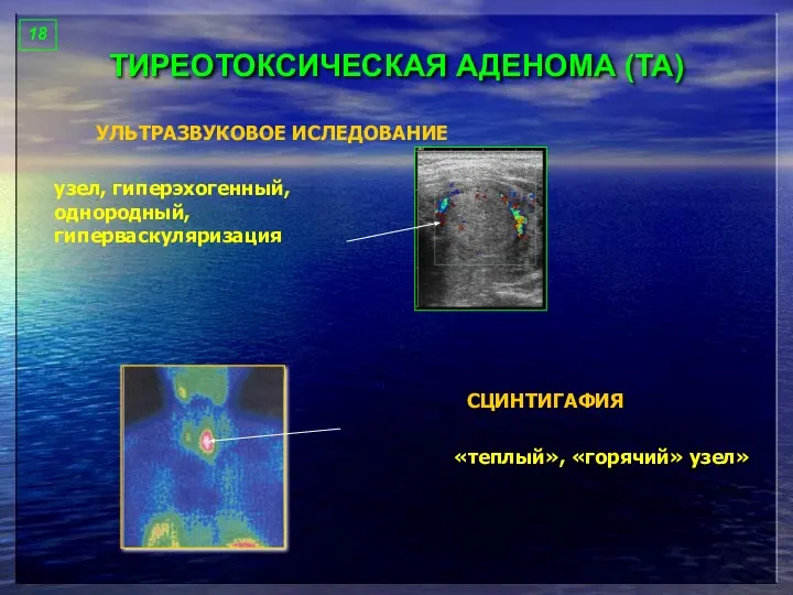 ТИРЕОТОКСИЧЕСКАЯ АДЕНОМА (ТА) 18 УЛЬТРАЗВУКОВОЕ ИСЛЕДОВАНИЕ узел, гиперэхогенный, однородный, гиперваскуляризация СЦИНТИГАФИЯ «теплый», «горячий» узел»