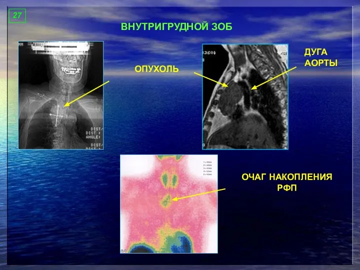 27 ВНУТРИГРУДНОЙ ЗОБ ОПУХОЛЬ ДУГА АОРТЫ ОЧАГ НАКОПЛЕНИЯ РФП