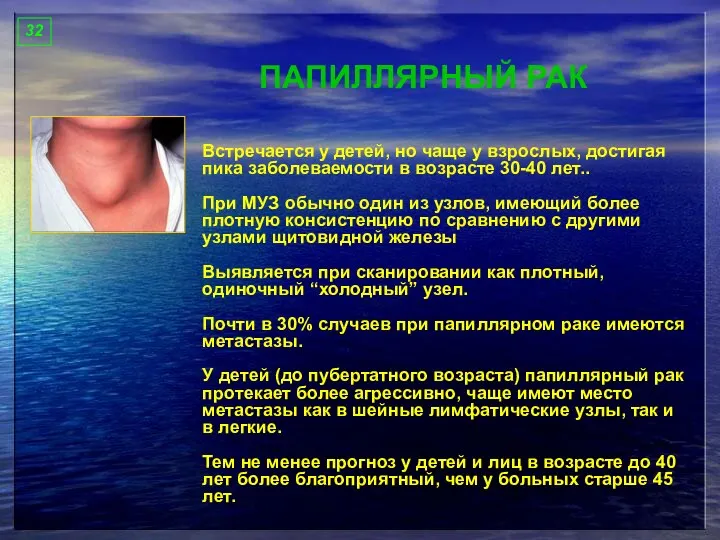 32 ПАПИЛЛЯРНЫЙ РАК Встречается у детей, но чаще у взрослых, достигая