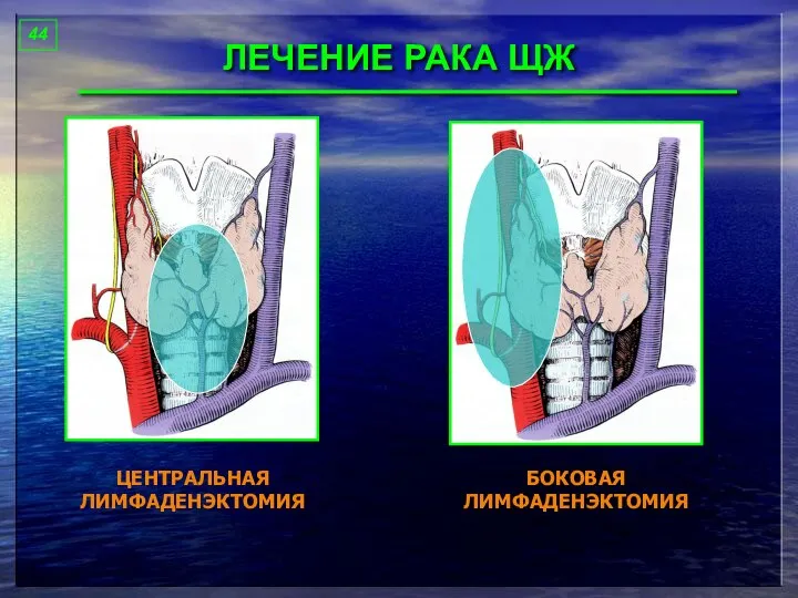 ЛЕЧЕНИЕ РАКА ЩЖ 44 ЦЕНТРАЛЬНАЯ ЛИМФАДЕНЭКТОМИЯ БОКОВАЯ ЛИМФАДЕНЭКТОМИЯ