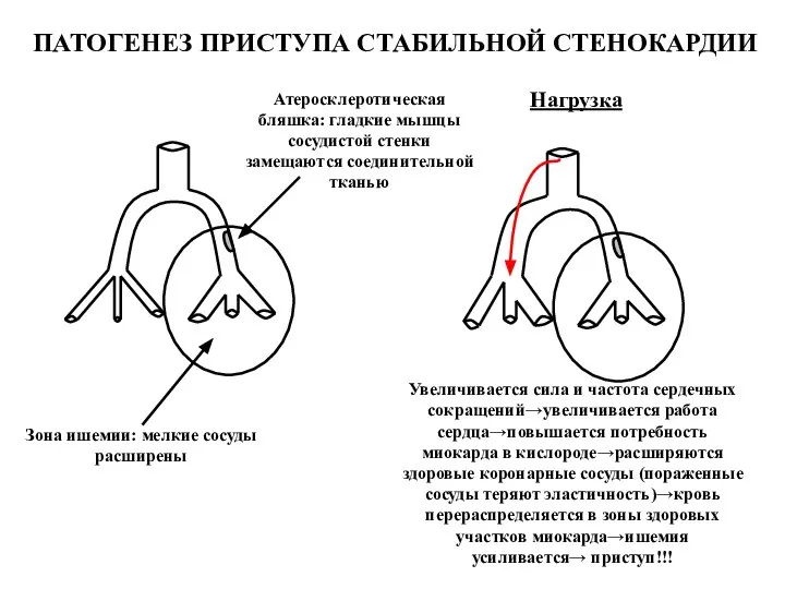 Атеросклеротическая бляшка: гладкие мышцы сосудистой стенки замещаются соединительной тканью Зона ишемии: