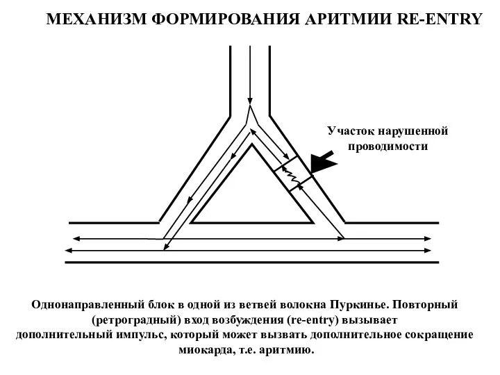 Участок нарушенной проводимости Однонаправленный блок в одной из ветвей волокна Пуркинье.