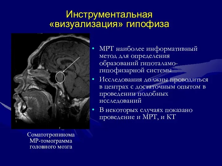 Инструментальная «визуализация» гипофиза МРТ наиболее информативный метод для определения образований гипоталамо-гипофизарной