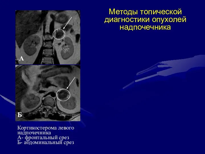 Методы топической диагностики опухолей надпочечника Кортикостерома левого надпочечника А- фронтальный срез Б- абдоминальный срез А Б