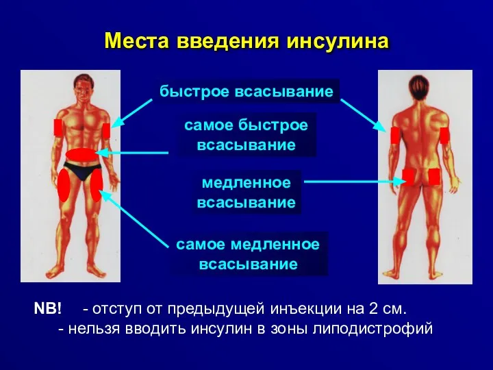 Места введения инсулина NB! - отступ от предыдущей инъекции на 2