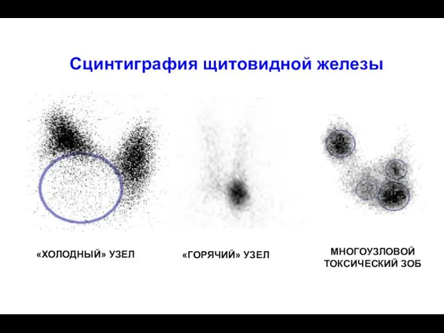 «ХОЛОДНЫЙ» УЗЕЛ «ГОРЯЧИЙ» УЗЕЛ МНОГОУЗЛОВОЙ ТОКСИЧЕСКИЙ ЗОБ Сцинтиграфия щитовидной железы