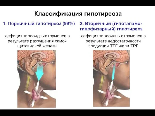 Классификация гипотиреоза 1. Первичный гипотиреоз (99%) 2. Вторичный (гипоталамо-гипофизарный) гипотиреоз дефицит