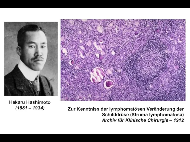 Hakaru Hashimoto (1881 – 1934) Zur Kenntniss der lymphomatösen Veränderung der