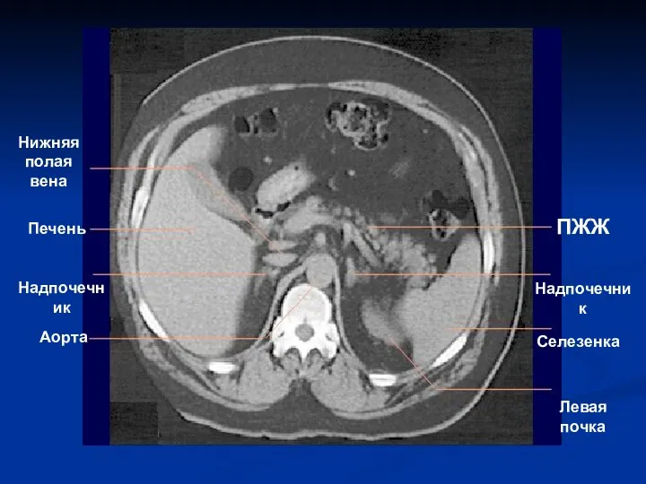 ПЖЖ Надпочечник Селезенка Левая почка Нижняя полая вена Печень Надпочечник Аорта