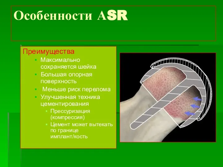 Особенности АSR Преимущества Максимально сохраняется шейка Большая опорная поверхность Меньше риск