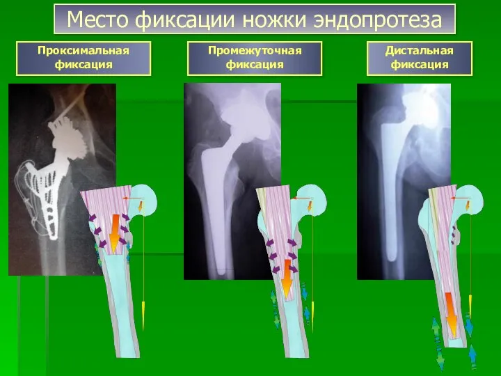 Место фиксации ножки эндопротеза Дистальная фиксация Проксимальная фиксация Промежуточная фиксация