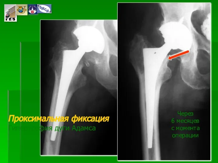 Проксимальная фиксация Гипертрофия дуги Адамса Через 6 месяцев с момента операции