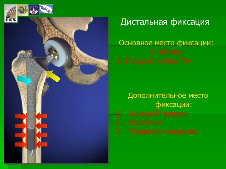 Дистальная фиксация Основное место фиксации: 1. Истмус 2. Посадка «press fit»