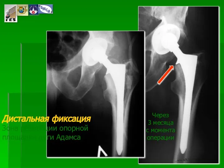 Дистальная фиксация Зона резорбции опорной площадки дуги Адамса Через 3 месяца с момента операции