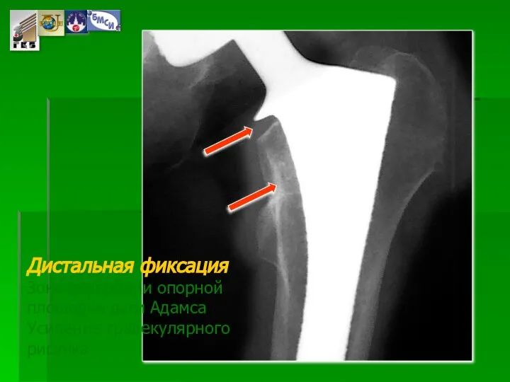 Дистальная фиксация Зона резорбции опорной площадки дуги Адамса Усиление трабекулярного рисунка