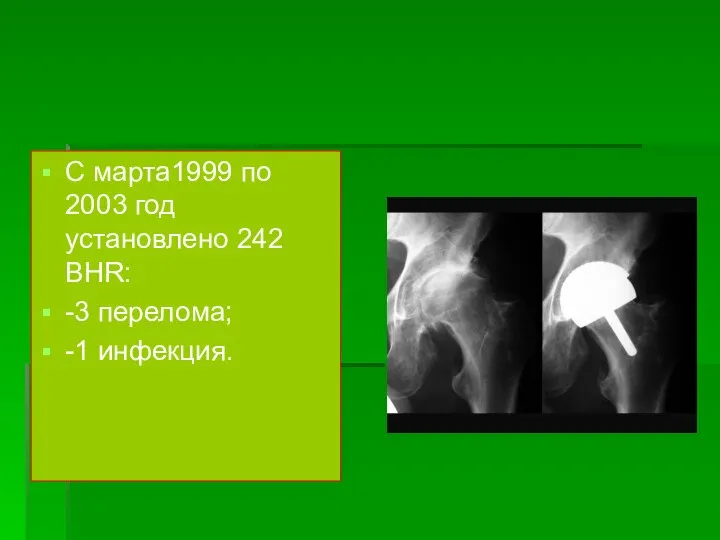 C марта1999 по 2003 год установлено 242 BHR: -3 перелома; -1 инфекция.