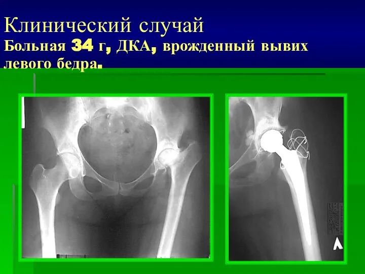 Клинический случай Больная 34 г, ДКА, врожденный вывих левого бедра.