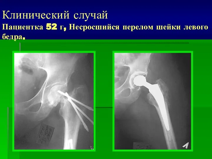 Клинический случай Пациентка 52 г, Несросшийся перелом шейки левого бедра.