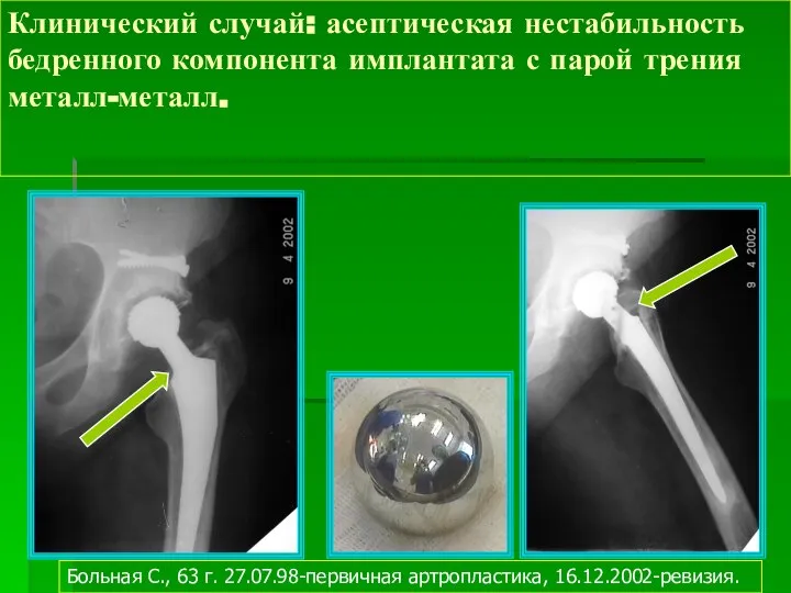 Клинический случай: асептическая нестабильность бедренного компонента имплантата с парой трения металл-металл.