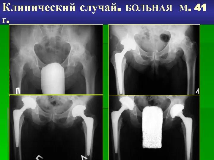 Клинический случай. БОЛЬНАЯ М. 41 г.