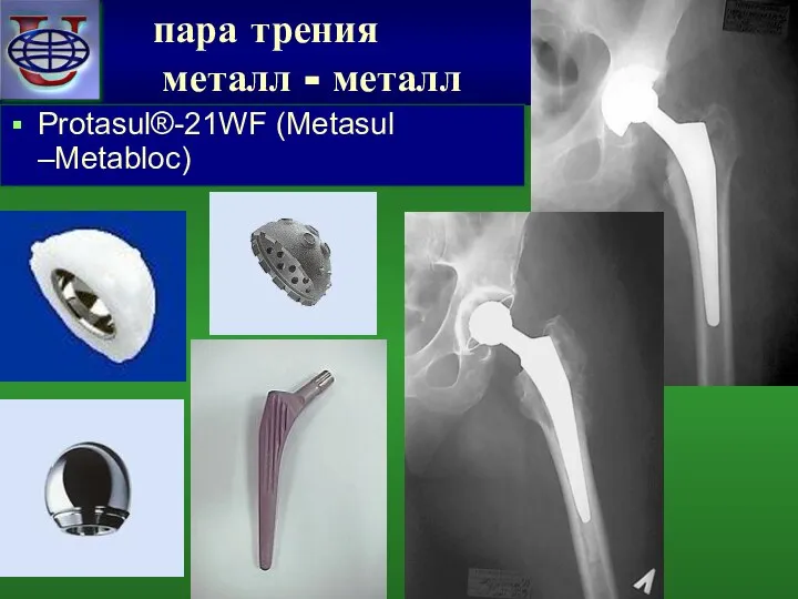 пара трения металл - металл пара трения металл - металл Protasul®-21WF (Metasul –Metabloc)