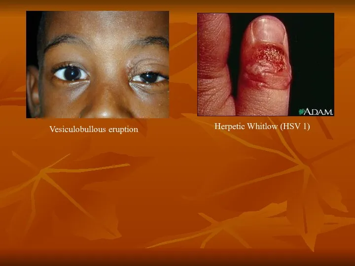 Vesiculobullous eruption Herpetic Whitlow (HSV 1)