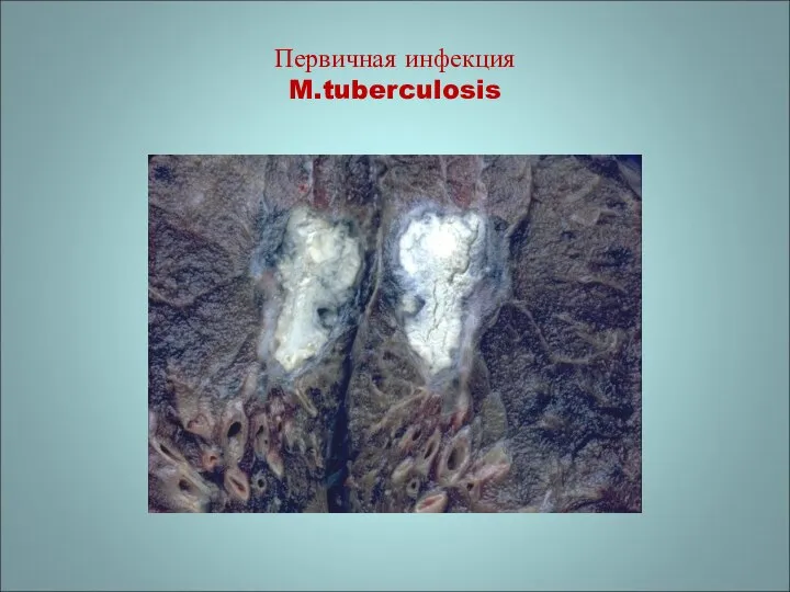 Первичная инфекция M.tuberculosis