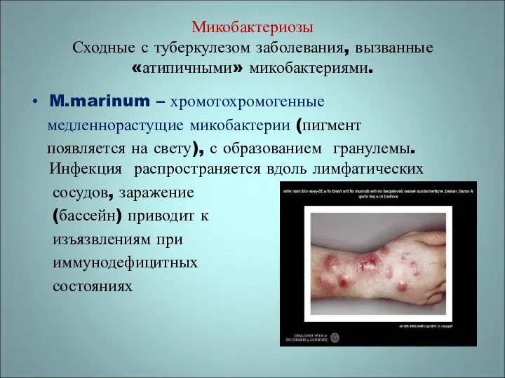 Микобактериозы Сходные с туберкулезом заболевания, вызванные «атипичными» микобактериями. M.marinum – хромотохромогенные