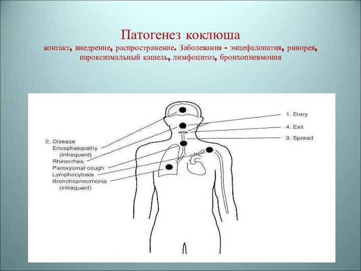 Патогенез коклюша контакт, внедрение, распространение. Заболевания - энцефалопатия, ринорея, пароксизмальный кашель, лимфоцитоз, бронхопневмония