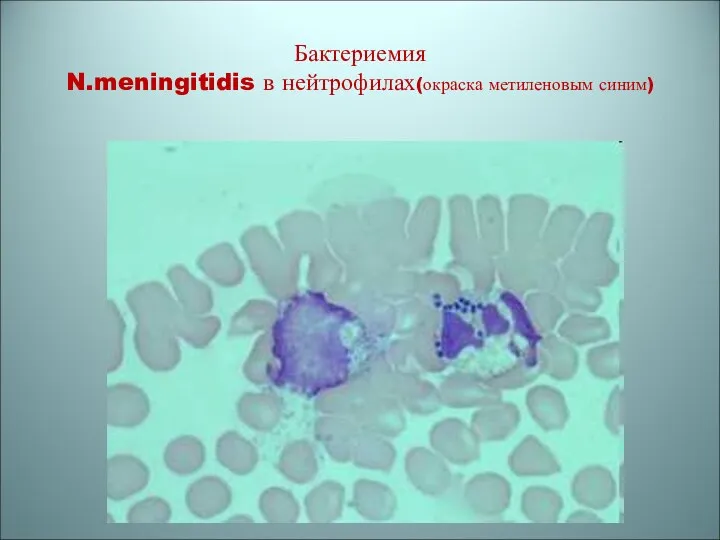 Бактериемия N.meningitidis в нейтрофилах(окраска метиленовым синим)
