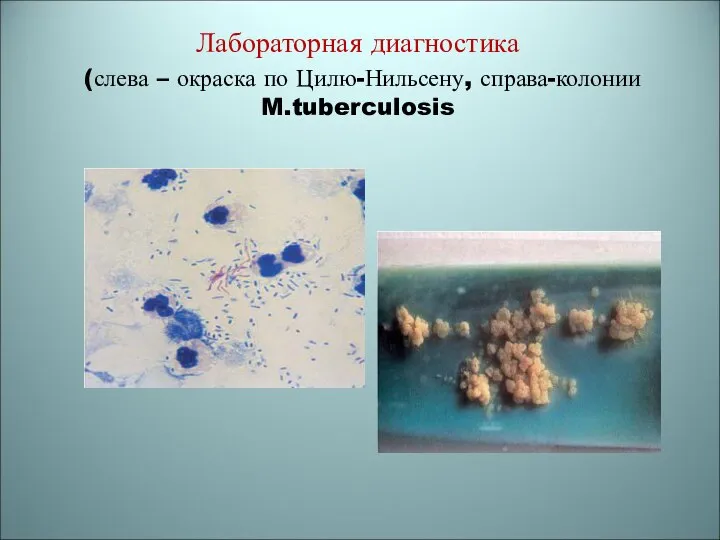 Лабораторная диагностика (слева – окраска по Цилю-Нильсену, справа-колонии M.tuberculosis
