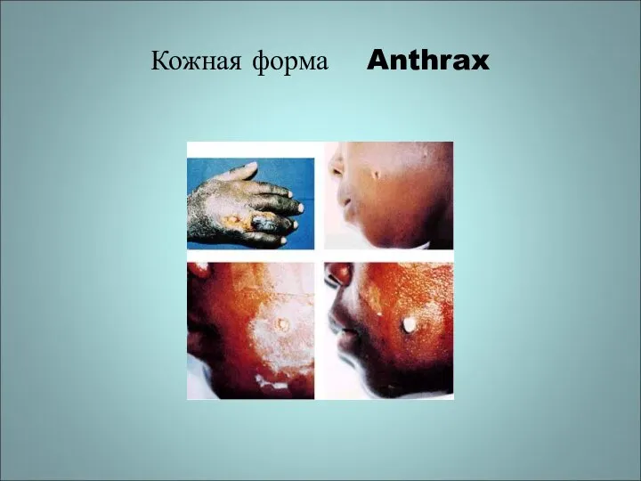 Кожная форма Anthrax