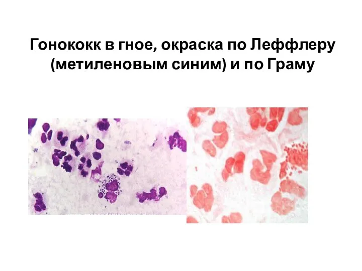 Гонококк в гное, окраска по Леффлеру (метиленовым синим) и по Граму