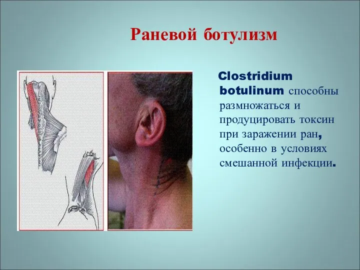 Clostridium botulinum способны размножаться и продуцировать токсин при заражении ран, особенно