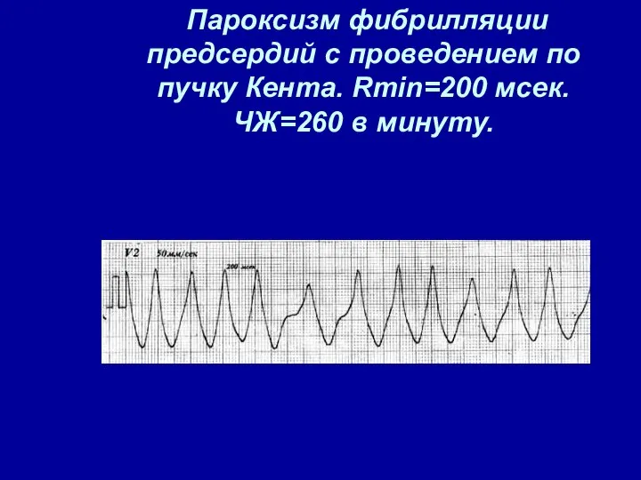 Пароксизм фибрилляции предсердий с проведением по пучку Кента. Rmin=200 мсек. ЧЖ=260 в минуту.