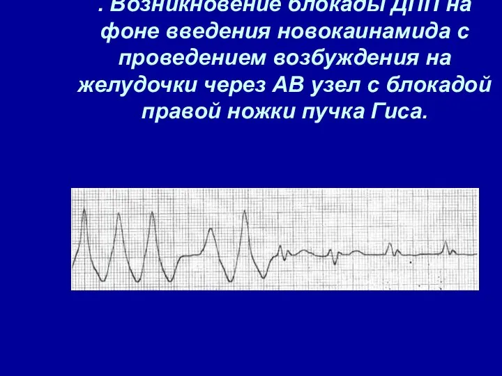 . Возникновение блокады ДПП на фоне введения новокаинамида с проведением возбуждения