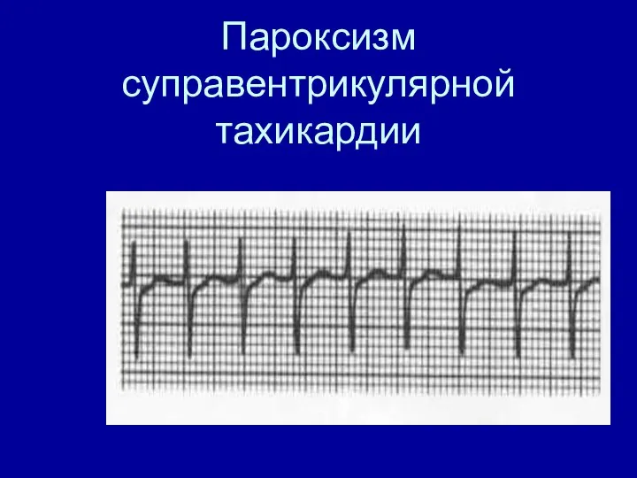 Пароксизм суправентрикулярной тахикардии